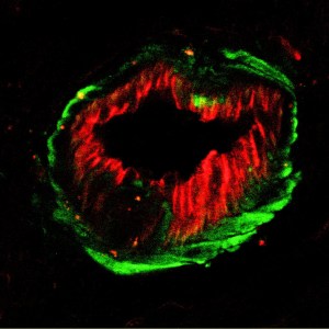 Dr Dinah Parums. Confocal fluorescence microscopy. CD31 (red) and ASMA (green).